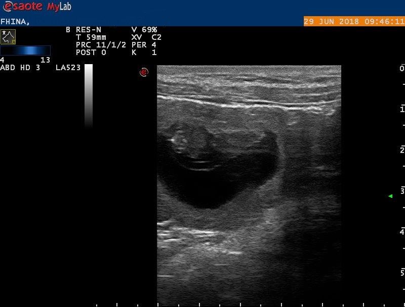 Ultraschallbild von Fhinas Bauch